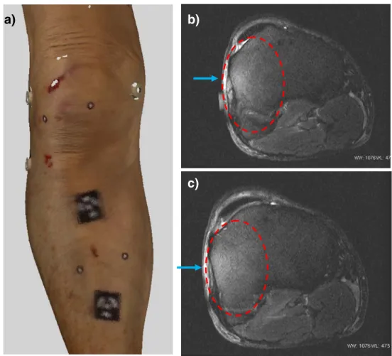 Fig. 7 Injuries of the right knee of a pedestrian who was hit by a car (case 5). a Suffusions with bruises over and under the patella of the right knee joint.
