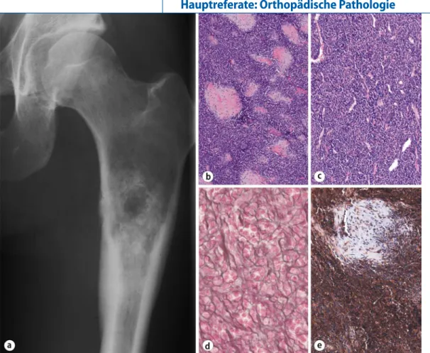 Abb. 9  9  Mesenchymales   Chondrosarkom.  a  Röntgen-übersicht, a.-p: Osteolyse  der proximalen  Femur-diaphyse umgeben von  teils ringförmigen  Verkal-kungen