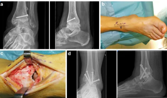 Fig. 3 a The preoperative radiographs of an elderly female patient who has been treated by total ankle replacement (TAR)