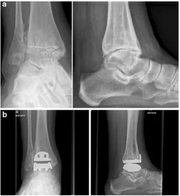 Fig. 4 a Preoperative radiographs of a female patient suffering from idiopathic ankle osteoarthritis