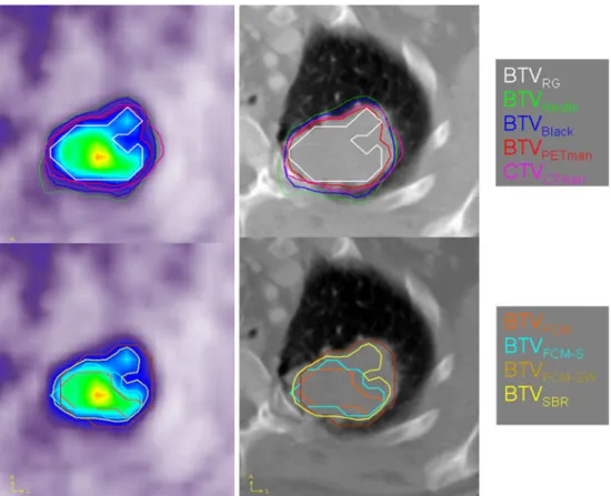 Table 3 Summary of comparative PET image segmentation results of the clinical study shown in Fig