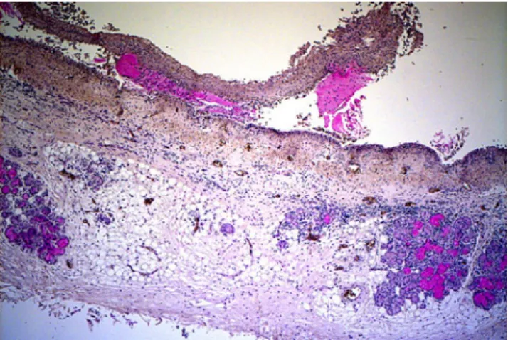 Fig. 4 Lung parenchyma. Sticking phenomenon was particularly evident at proximity of the bronchial tree (immunohistochemical reaction with NP57, ×200)