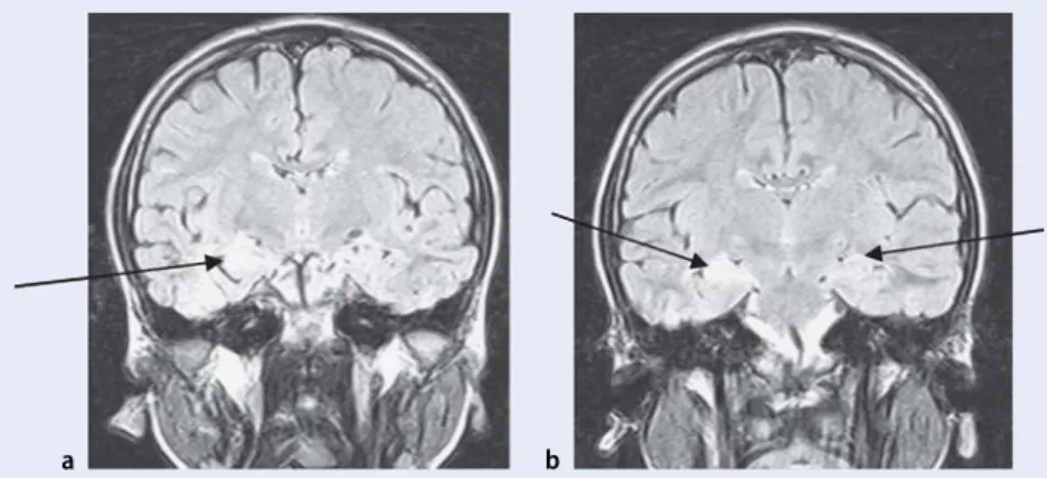 Abb. 4  8  7-jähriger Knabe mit Hippocampussklerose, a nach prolongiertem Fieberkrampf im Alter  von 3 Jahren, b erneute generalisierte Anfälle 3 Monate vor MRT-Untersuchung