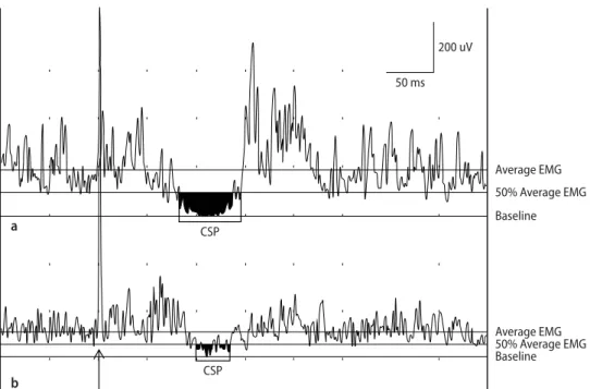 Fig. 1 CSP in the right APB of a healthy  control (a) and the patient (b).  Stimula-tion of second digit at 13 × sensory threshold (ST) in (a) and at 16 × ST in  (b)  (arrow)