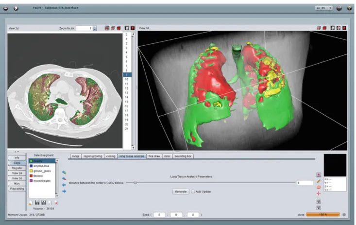 Fig. 11 Segmentation of the lung tissue using YaDiV. A “lung tissue analysis” tab was created to run the blockwise feature extraction and classification