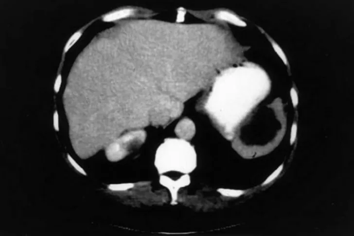 Fig. 2 Appearance of new AE localizations after LT for AE. In this patient an abdominal CT scan systematically performed 2 years after LT allowed the discovery of a splenic AE metastasis.