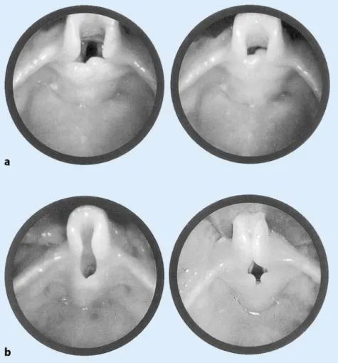 Abb. 1  8   La ryn go ma la zie.  Ob struk ti on  des  Atem we ges  wäh rend  der  In spi ra ti on  durch a den  Vor fall  der  Ary te noid hö cker  und  arye piglot ti schen  Fal ten, b Kol laps der Hin ter rän der der  Epiglot tis
