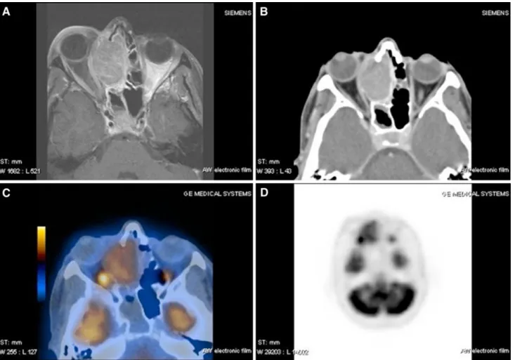Fig. 1 56-year-old female suVering from a sinonasal malignant mela- mela-noma originating from the right nasal cavity involving the ethmoid  si-nus, the dura, and the periorbit