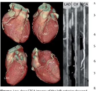 Figure 1. Low-dose CTCA images of the left anterior descend- descend-ing artery (LAD), the circumflex artery (CX), and the right  coronary artery (RCA) rule out the presence of CAD.