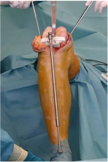 Fig. 1 An extramedullary alignment rod can be fixed onto the tibial MyKneeÓ cutting block as an additional checking tool