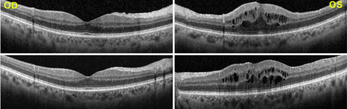 Fig. 2 FA showing cystoid macular oedema in the left eye (bottom pictures)