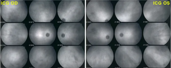 Fig. 4 OCTs of right and left maculas showing resolution of CMO OS after anti-tuberculous therapy; the left macula still showing an increased thickness (right picture)