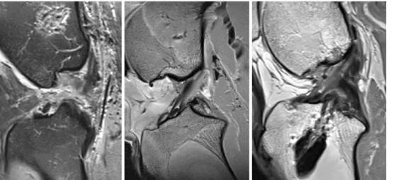 Fig. 3 AP laxity of healthy ACL, DIS-repaired ACL (after 3 months of self-healing), and ruptured ACL