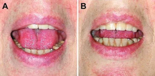 Figure 2. Case 1: Evolution of symptomatic trismus. The patient was instructed to maximally open  her mouth at admission (A) and on the following day (B).