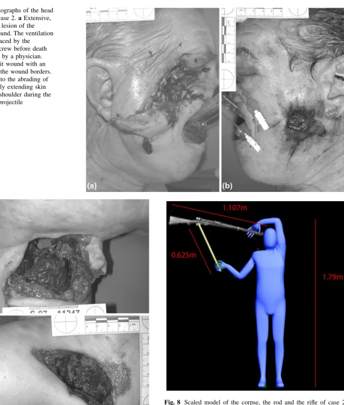 Fig. 7 Photographs of the left shoulder/upper arm region of case 2.