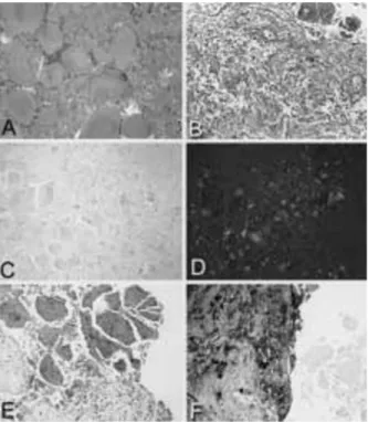 Fig. 2 - Pathology findings. The specimen consisted of several fragments of amorphous material