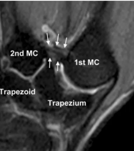 Fig. 6 a Coronal (2,039/25) and b sagittal (2,000/24 ms) intermediate-weighted fat-saturated MR images show loss of cartilage (in between the arrows) of the first metacarpal base and the trapezium in a 36-year-old asymptomatic volunteer
