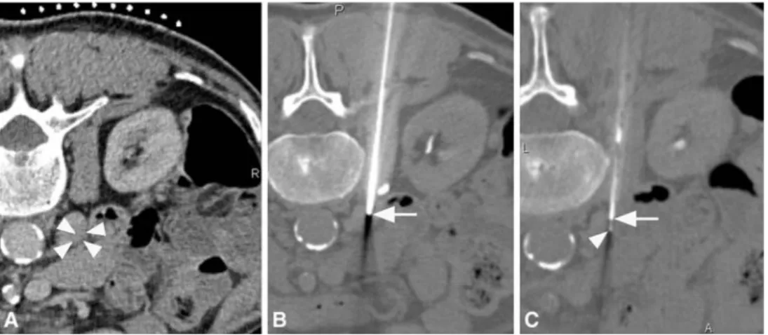 Fig. 2 CT-guided percutaneous biopsy performed using a coaxial technique (A–C, axial views)