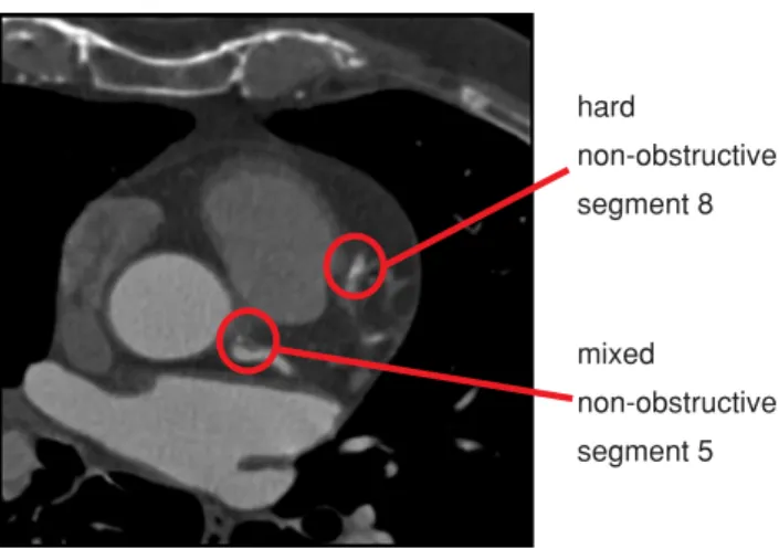 Fig. 2 Axial slice from a CTCA data set of the human heart. For ground truth, coronary plaques (indicated by red circles) were manually labeled by an experienced radiologist according to their type, degree of stenosis and segment position within the corona