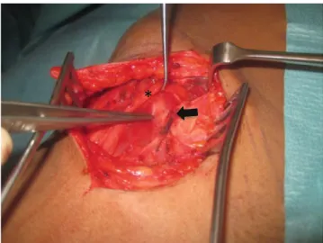 Fig. 2 Attachment of the superficial thigh fascia to the underlying fibrous strand of the sartorius muscle (black arrow) and identification of the LFCN (asterisk)