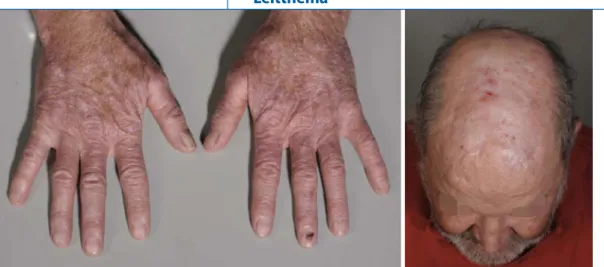 Abb. 1  9  Eine ausgedehn-  Eine ausgedehn-te Feldkanzerisierung der  Haut, wie hier im Bereich  der sonnenexponierten   Handrücken und Finger- rücken oder des androge- netischen Areals des Ca-pillitiums zu sehen, sollte   bei einem organtransplan- tierten