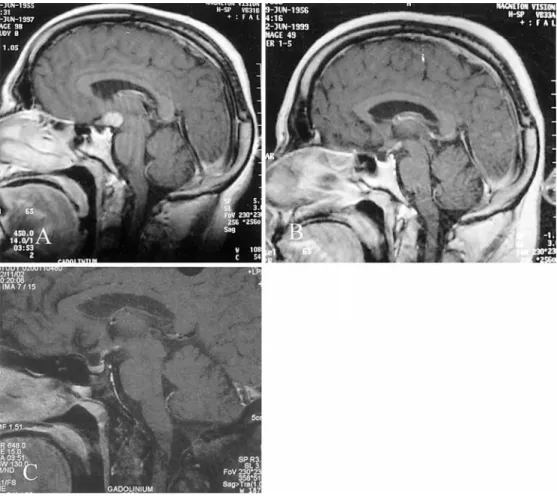 Fig. 2 Periapical radiographs showing well-defined radiolucency associated with the apex of the right mandibular second molar (A) and mandibular incisors (B)