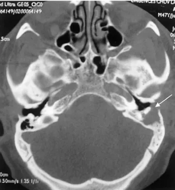 Fig. 6 Technetium-99-m bone scan showing a lesion of the distal epiphysis of the left femur, the persistence of a left temporal and mandibular lesions and a frontal bone lesion