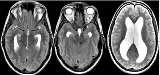 Fig. 2 Preoperative MRI showing a triventricular hydrocephalus with an unusual shape of the third ventricle, squeezed posteriorly (a) and dilated anteriorly (b)
