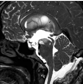 Fig. 4 Endoscopic view of the lateral right ventricle with a barely visible foramen of Monro (a)