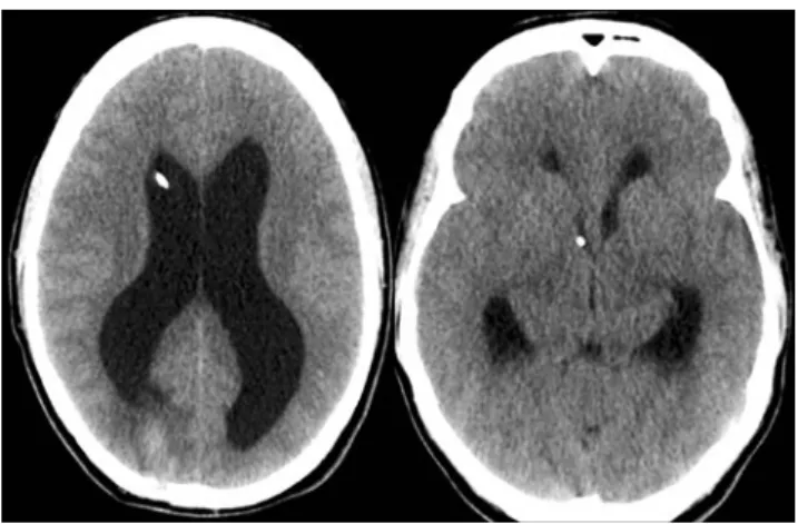 Fig. 5 Cerebral CT scan after EVT: the third ventricle dilation re- re-solved whilst a biventricular hydrocephalus is still present, reflecting the bilateral stenosis of the foramina of Monro