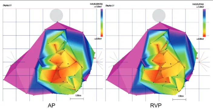 Fig. 2. Electroanatomic bipolar voltage maps of the left ventricle in atrial pacing and right ventricular pacing are shown in a posterior projection