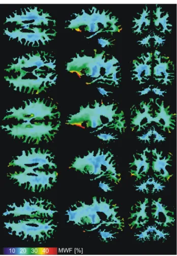 Fig. 5 Axial, sagittal and coronal sample images from five healthy volunteers showing 1.3 mm isotropic high-resolution MWF  parame-ter estimates as derived from two-pool bSSFP model fitting using the NLLS algorithm and the extended bSSFP fit equation (Eq
