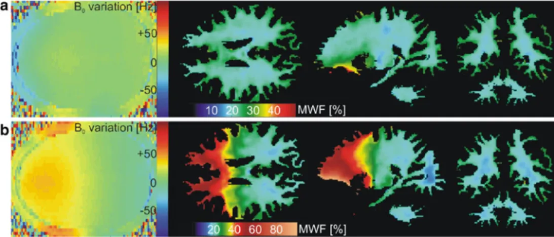 Fig. 6 Right: axial, sagittal and coronal sample images of a sixth healthy volunteer showing 1.3 mm isotropic high-resolution MWF parameter estimates as derived from two-pool bSSFP model fitting using the NLLS algorithm and the extended bSSFP fit equation 