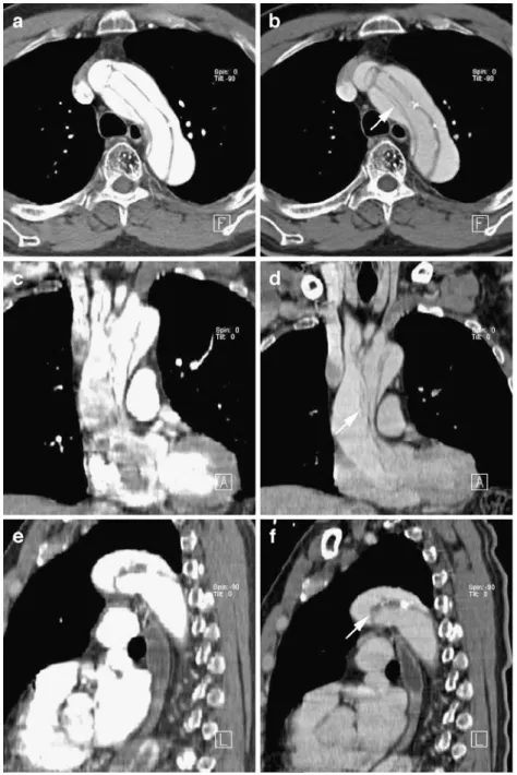 Fig. 4 Axial CT image in lung window settings showing a lung contusion (arrow) on the left side in a patient after blunt chest trauma