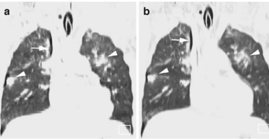 Fig. 5 Coronal MPRs showing lung contusions (arrowhead) in both lungs and a right-sided pneumothorax (arrow) in a  me-chanically ventilated  38-year-old male patient after blunt chest trauma