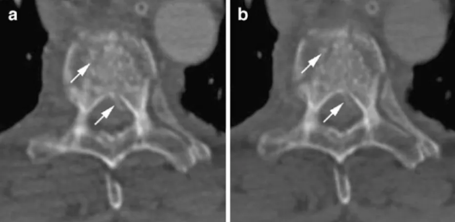 Fig. 7 Axial CT image showing a compression fracture of the sixth thoracic vertebra after blunt chest trauma