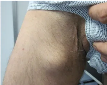 Fig. 2 Intraoperative Wndings of the primary venous aneurysm of the proximal saphenous vein
