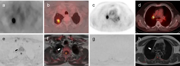 Fig. 2 Sample case of a 55-year-old man with pT2b pN1, UICC IIB squamous cell carcinoma