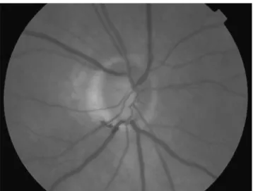 Fig. 1 Inferior acquired pit of optic nerve (APON)