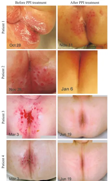 Fig. 2. Photographs of perianal skin conditions in patients 1-4 before  and after 3-10 weeks of potato derived protease inhibitor treatment.