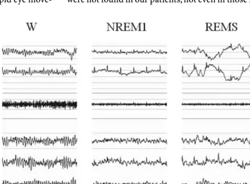 Fig. 1 54-year-old male patient (RM) with a 7-year history of idiopathic Parkinson’s disease and with a subjective complaint of excessive daytime sleepiness.