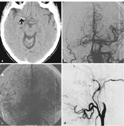 Table 1. Characteristics of patients undergoing intracranial stenting. F: female; L: left; M: male; NIHSS: National Institutes of Health Stroke Scale; 