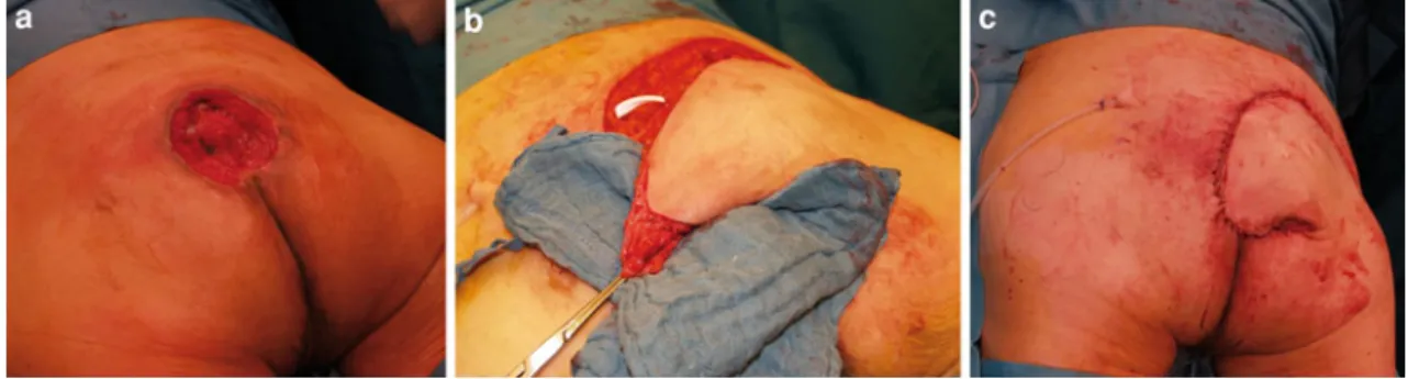 Fig. 1 Sacral pressure sore and small flap