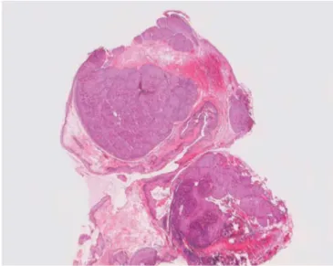 Fig. 4 Higher magnification showing intracytoplasmic eosinophilic structures, the so-called molluscum bodies