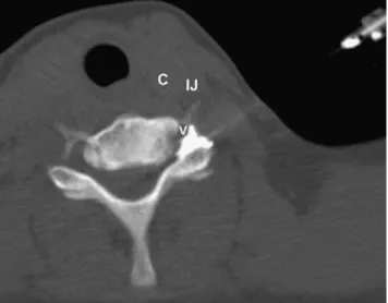 Fig. 3 Direct cervical transforaminal nerve root injection. The needle and contrast material are located within the intervertebral foramen.