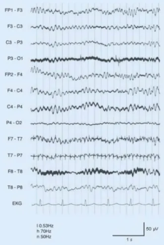 Abb. 2  9  Al pha- pha-Koma-EEG