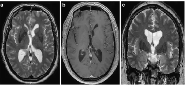 Fig. 4 Follow-up MRI at 24 months a transverse T2-weighted image, b transverse T1-weighted image and c coronal T2-weighted image