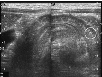 Fig. 1 Ileocecal intussusception in an 8-year-old boy. Linear transducer shows a large-bowel intussusception with intramural echogenic foci (circle)