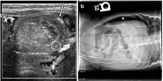 Fig. 4 Ileocecal intussusception in a 4-year-old boy. a Short-axis view shows echogenic mucosal fold mimicking intramural gas (arrow)