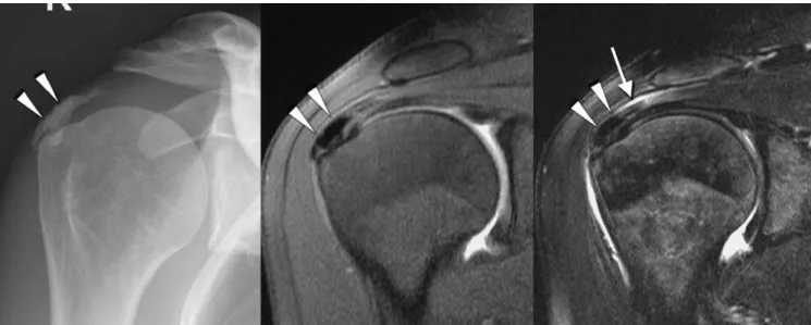 Fig. 2 42-year-old woman with a true positive calcific tendinitis of the supraspinatus tendon